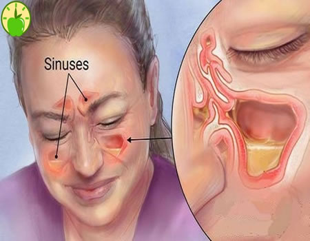 chronic sinus infection
