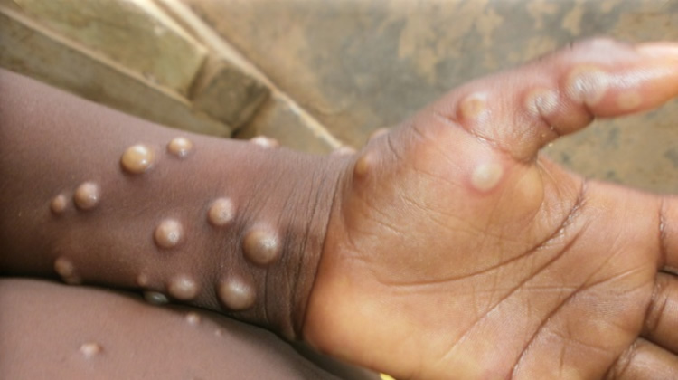 Mpox : les enfants sont les plus touchés parmi les 48 cas confirmés — NCDC