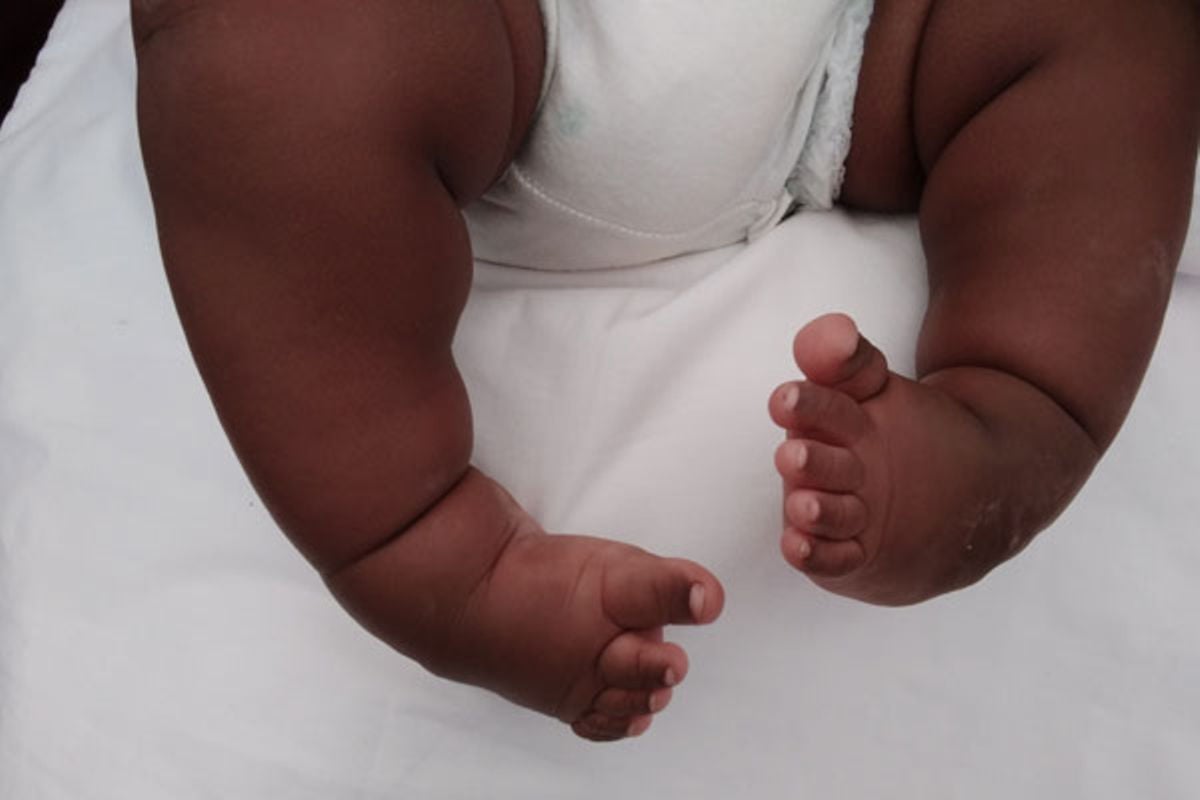 clubfoot treatment clubfoot treatment by traditional bone setters