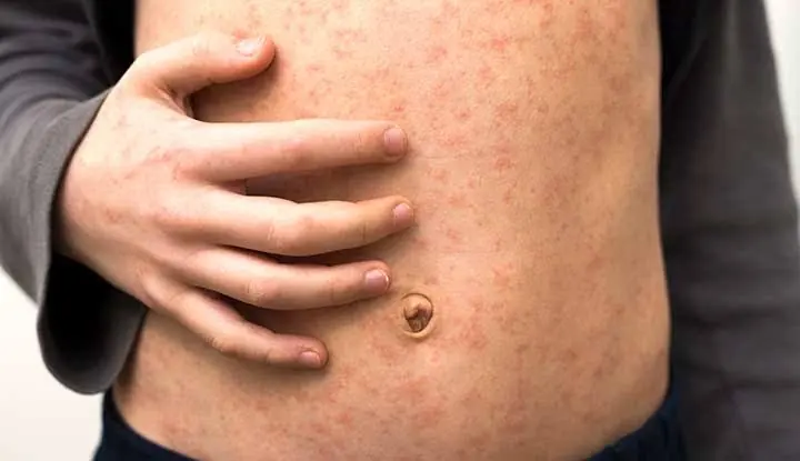 Rubella like measles Measles US second death