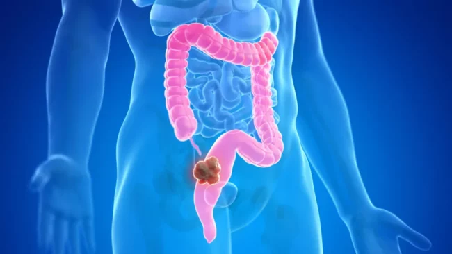Les personnes souffrant de saignement rectal à risque de cancer colorectal - étudient