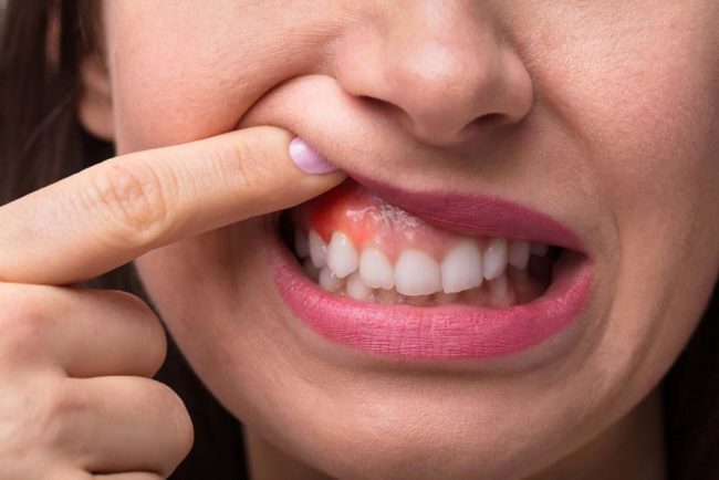 bleeding gums gum