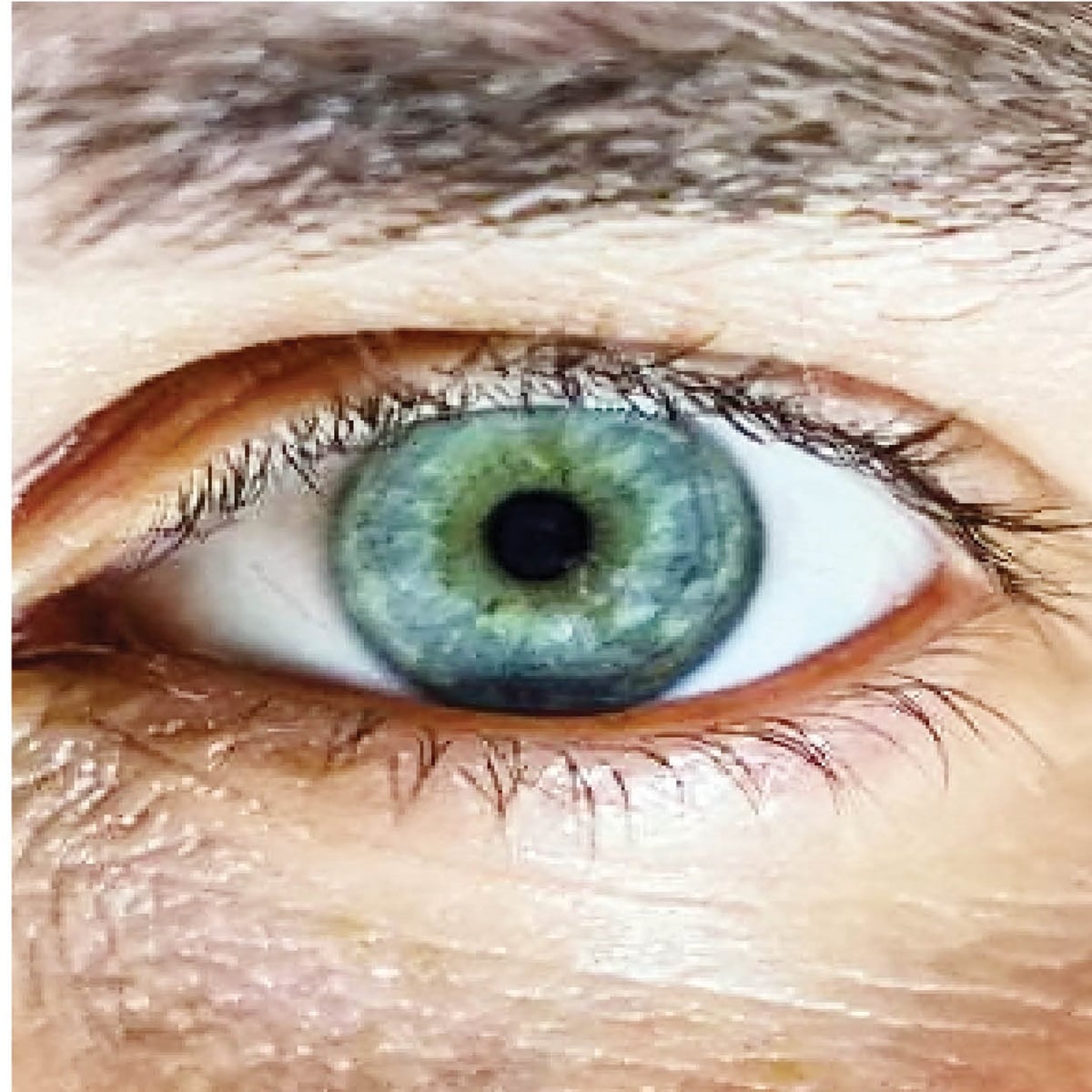 is glaucoma Early signs of glaucoma