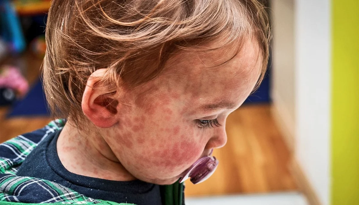Measles disease US measles cases top 1,000 for first time in five years